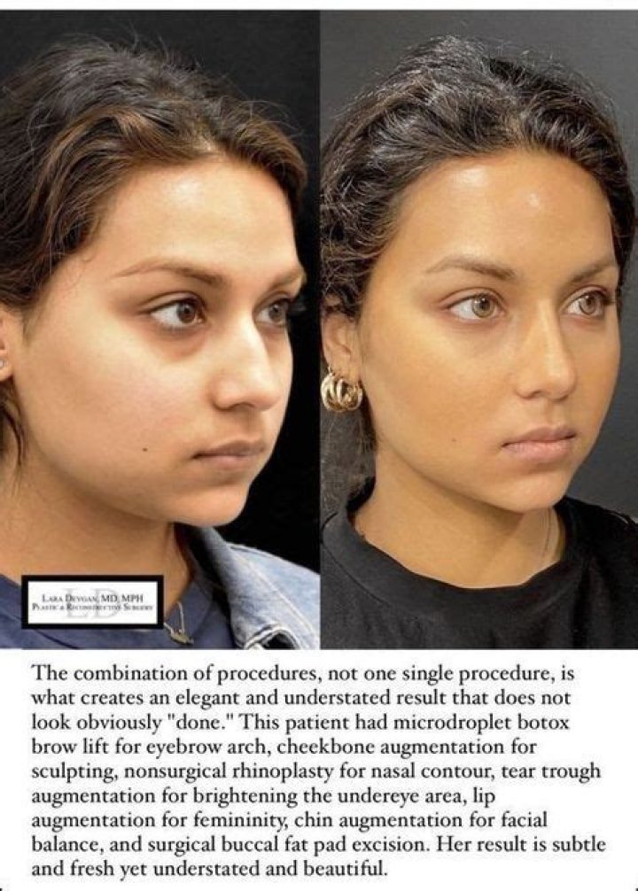 Facial Fillers Fab + Expensive How Many Syringes
