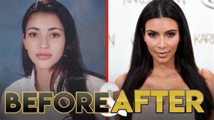 Kim Kardashian Plastic Surgery Before and After Transformations