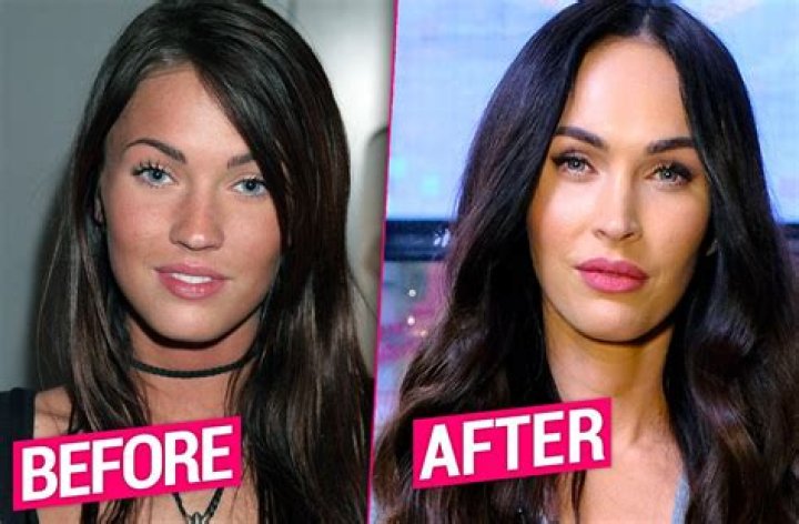 Megan Fox Plastic Surgery, Plastic Surgery Photos, Celebrity Plastic