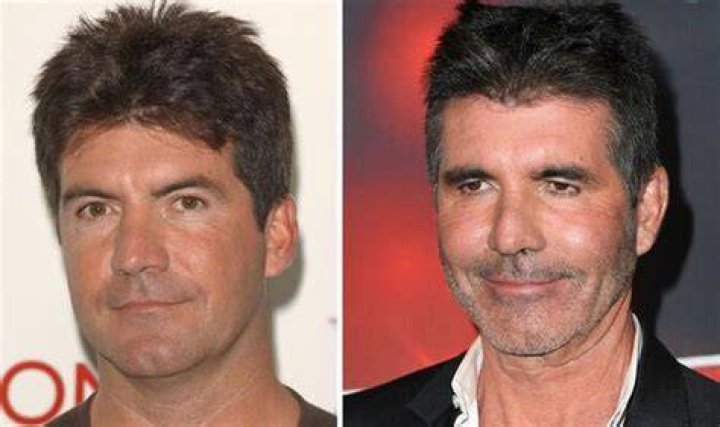 Simon Cowell&rsquo;s drastically different face Botox, &lsquo;too much&rsquo; filler and &pound;2k facelift