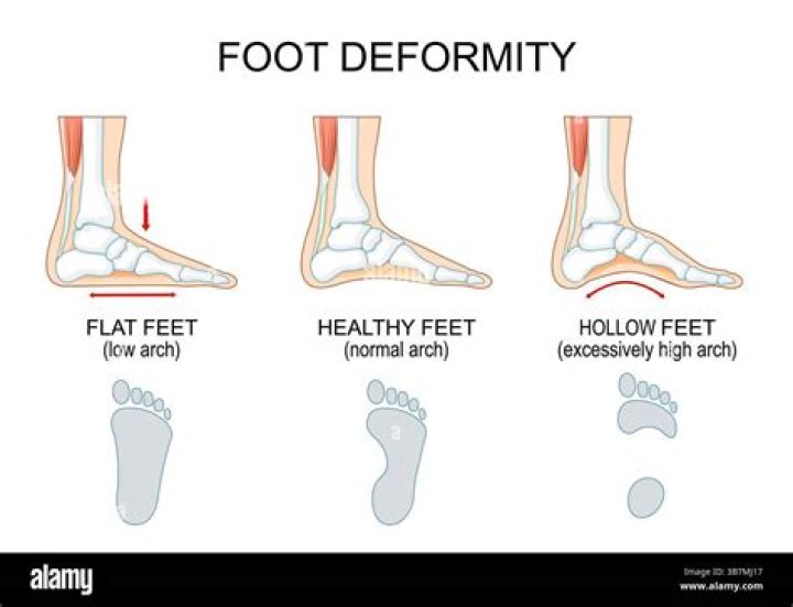 What Are High Arch And How To Fix Them! Marietta Foot Doctor